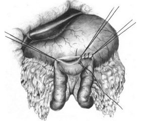 Клинический случай операции гастроэнтеростомии с брауновским соустьем под эпидуральной анестезией