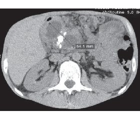A case of successful radical surgical treatment of chronic pancreatitis complicated by a giant pseudoaneurysm of the common hepatic artery