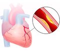 Diagnosis of the presence of myocardial stunning phenomenon in clinical settings using instrumental methods of research