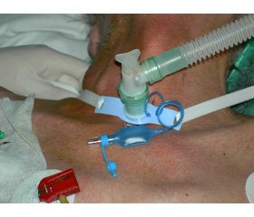 Роль санационной терапии носоглотки и ротовой полости в профилактике гнойных осложнений верхних дыхательных путей у пациентов, находящихся на длительной искусственной вентиляции