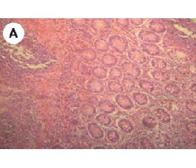 Стан IgG4-позитивних плазматичних клітин у слизовій оболонці товстої кишки при хронічних запальних захворюваннях кишечника
