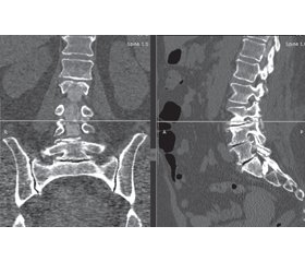 Дослідження результатів застосування  КТ-мієлографії у хворих на стеноз поперекового відділу хребтового каналу