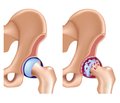 Роль параметрів остеосцинтиграфії в діагностиці імплант-асоційованих параендопротезних ускладнень при ендопротезуванні кульшових  та колінних суглобів