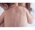 Congenital measles (clinical case)