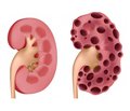 Registration and management of patients with chronic kidney disease stage 3-5 and acute kidney injury