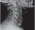 Features of course and surgical treatment of tonsillogenic neck phlegmons and mediastinitis