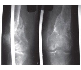 Тактико-технологічні особливості лікування ушкодження дистального метаепіфіза  стегнової кістки