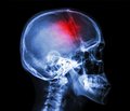 Особенности лечения больных в восстановительном периоде черепно-мозговой травмы