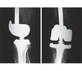 Characteristics of endoprosthesis replacement of bones and joints in patients with metastatic lesions