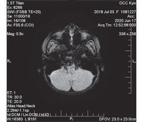 Клінічний випадок синдрому Луї-Бар з клінічною картиною мозочкової атаксії та EBV-індукованого лімфопроліферативного синдрому