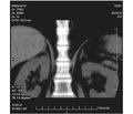 Computed Tomography Characterization of Adrenal Neoplasm