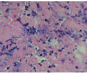 Поляризаційна мікроскопія колагенових волокон строми інвазивного перехідно-клітинного раку сечового міхура після неоад’ювантної ендолімфатичної хіміо- та променевої терапії