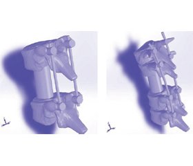 Дослідження конструкції заднього спондилодезу при втраті опороздатності переднього комплексу грудного й поперекового відділів хребта