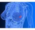 Опції ад’ювантної гормонотерапії раку молочної залози в пацієнток у пременопаузі