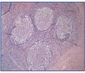 Морфологические особенности лимфоидных структур носоротоглотки у детей с гиперплазией лимфоглоточного кольца