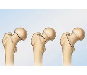 Сучасний стан лікування перипротезних переломів стегнової кістки