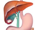 Масивна фатальна тромбоемболія легеневої артерії після холецистектомії міні-доступом з приводу гострого деструктивного калькульозного холециститу