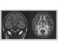 Психоэмоциональные нарушения у пациентов с височной эпилепсией и их морфологическое обоснование