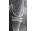 Analysis of the results of monocondillary endoprosthesis in conditions of low bone density of bone tissue
