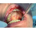 Клінічні аспекти діагностичного процесу потенційно злоякісних процесів слизової оболонки порожнини рота