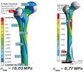 Порівняльний аналіз надійності фіксації черезвертлюгових переломів стегнової кістки із застосуванням звичайного та подовженого проксимального стегнового стрижня