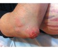 Difficulties and Mistakes in the Management of the Patient with Gout