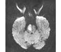 Neuroprotection after systemic thrombolysis in patients with ischemic stroke: a case report