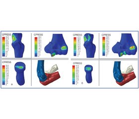 Математическое моделирование контактных напряжений и объема движений в локтевом суставе при переломе блока плечевой кости со смещением