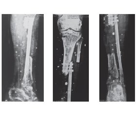 Реконструкція складних випадків септичних незрощень великогомілкової кістки
