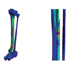 Дослідження напружено-деформованого стану моделі гомілки з переломом середньої третини великогомілкової кістки при різних варіантах остеосинтезу в умовах зростаючого стискаючого навантаження на систему «імплантат — кістка»
