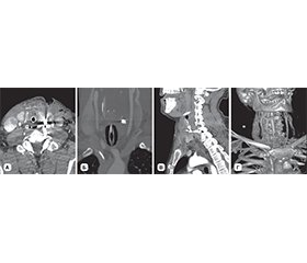 Класифікація вогнепальних поранень щитоподібної залози