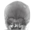 Experience of using deep brain stimulation in patients with Parkinson’s disease and psychoneurological comorbidities