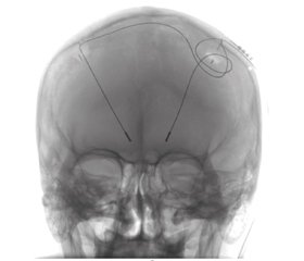 Experience of using deep brain stimulation in patients with Parkinson’s disease and psychoneurological comorbidities