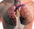 Профессиональные заболевания легких: оптимизация диагностических мероприятий