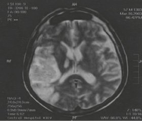 Перехресно-мозочковий діашиз у пацієнтів iз гострим інсультом: аналіз та презентація клінічних випадків