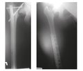 Тотальное эндопротезирование тазобедренных суставов при осложнениях остеосинтеза шейки бедренной кости в условиях регионального центра эндопротезирования крупных суставов на базе областной больницы интенсивного лечения г. Мариуполя