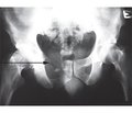 Ефективність застосування спіральної комп’ютерної томографії при діагностиці пухлин кісток таза