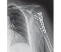 Choice of the method of surgical treatment for multifagmentary fractures taking into account disorder of the blood supply to the proximal humerus