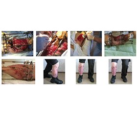 Одночасне лікування дефектів великогомілкової кістки та дефектів м’яких тканин з використанням дистракційного остеогенезу