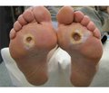 The Short-Term and Long-Term Results of Surgical Treatment for Diabetic Foot Syndrome and Evaluation of the Quality of Life of Patients (Literature Review)