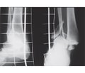 Застосування поєднаної стабільно-еластичної фіксації нестабільних ушкоджень  гомілковостопного суглоба при черезсиндесмозних переломах малогомілкової кістки