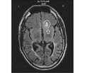 Симптоматическая эпилепсия у больных рассеянным склерозом (обзор литературы и разбор собственных клинических случаев)
