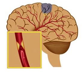 Возможности нейропротекции в комплексной терапии черепно-мозговой травмы