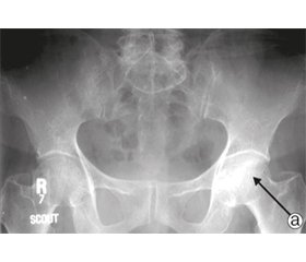 Роль остеосцинтиграфии и рентгенографии у пациентов с аваскулярным некрозом головки бедренной кости при эндопротезировании тазобедренных суставов