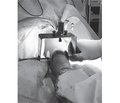 Обґрунтування способу визначення клініко-рентгенограмометричних показників кульшового суглоба в пацієнтів із ДЦП