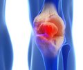 Комплексна фізична реабілітація хворих із диспластичними деформаціями колінного суглоба