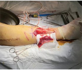 Використання клаптя переднього великогомілкового м’яза для створення ВДММ при транстибіальній ампутації для запобігання утворенню невроми поверхневого малогомілкового нерва: опис хірургічної техніки