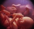 Зіставлення стану фетоплацентарного кровотоку   та перебігу раннього неонатального періоду   в новонароджених від багатоплідної вагітності