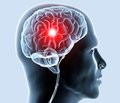 Діагностика та лікування хронічної ішемії головного мозку